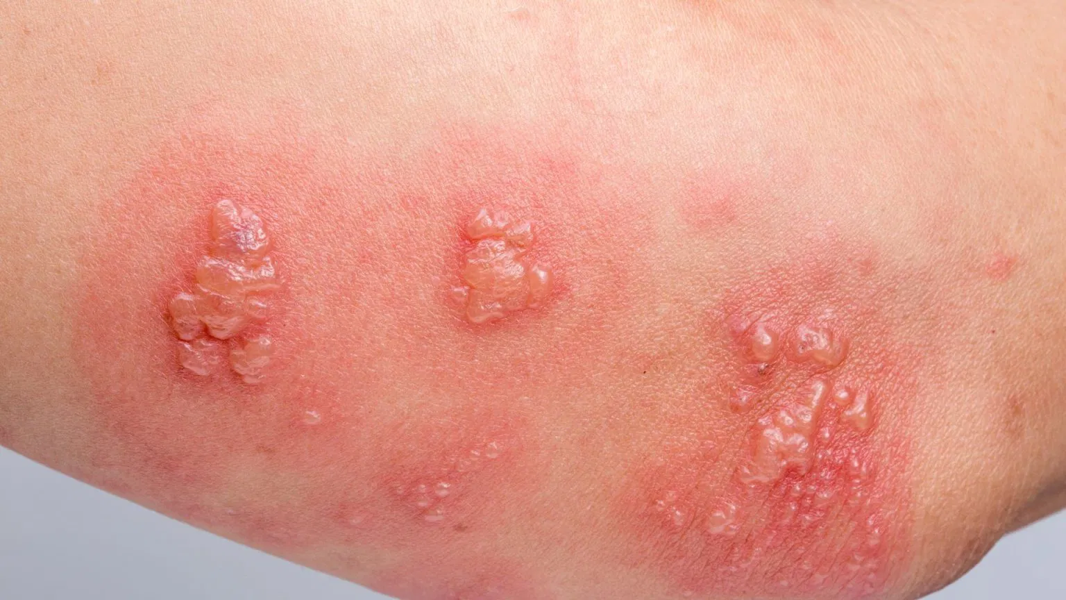 Virus Herpes: Cara Penularan Dan Tips Agar Terhindar