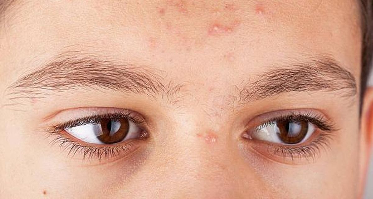 Jerawat Dahi Gak Mau Pergi? Ini Dia Pelaku Utamanya!