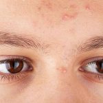 Jerawat Dahi Gak Mau Pergi? Ini Dia Pelaku Utamanya!