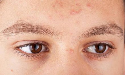 Jerawat Dahi Gak Mau Pergi? Ini Dia Pelaku Utamanya!