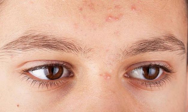 Jerawat Dahi Gak Mau Pergi? Ini Dia Pelaku Utamanya!